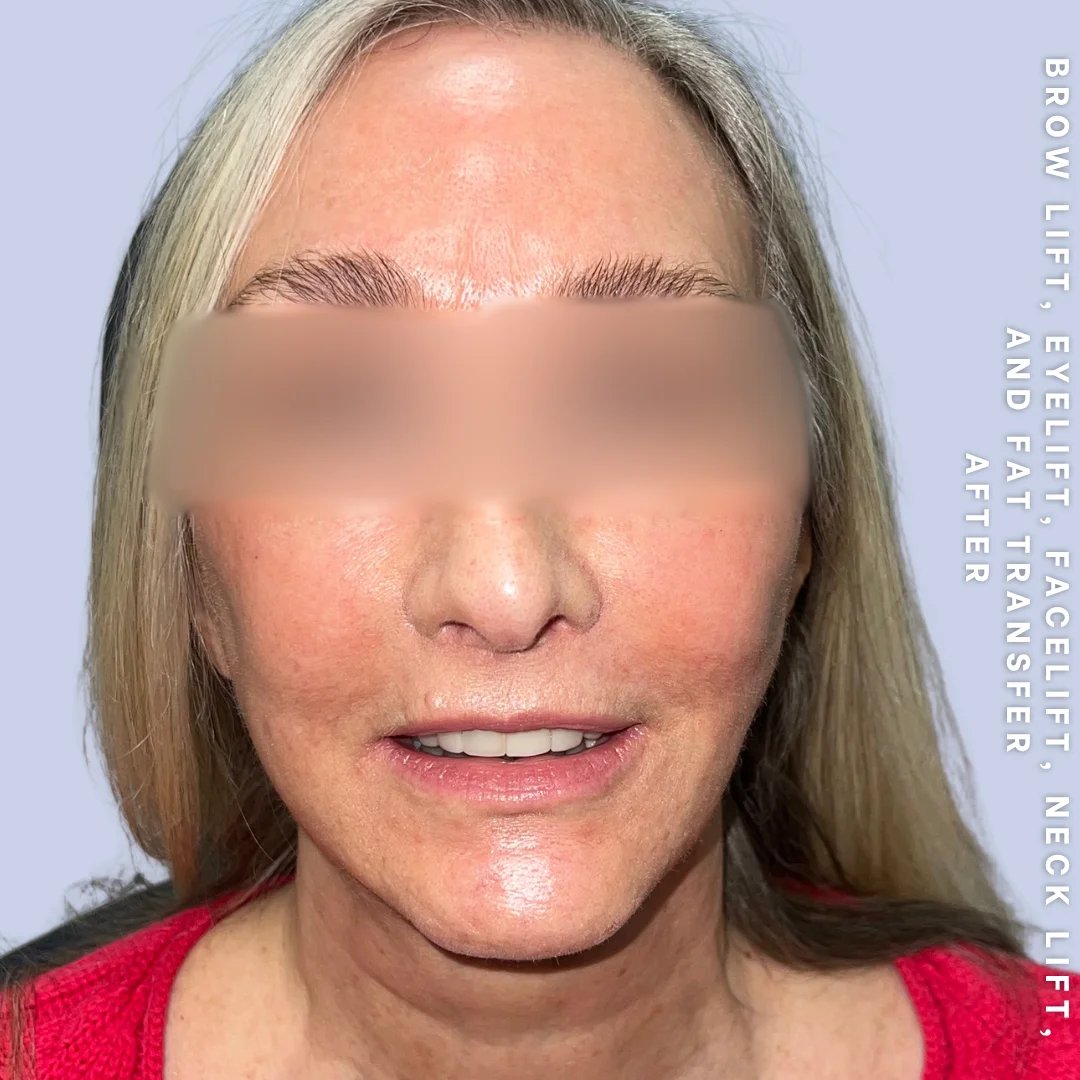 Face & Neck Before & After Gallery - Patient 18 - Image 3