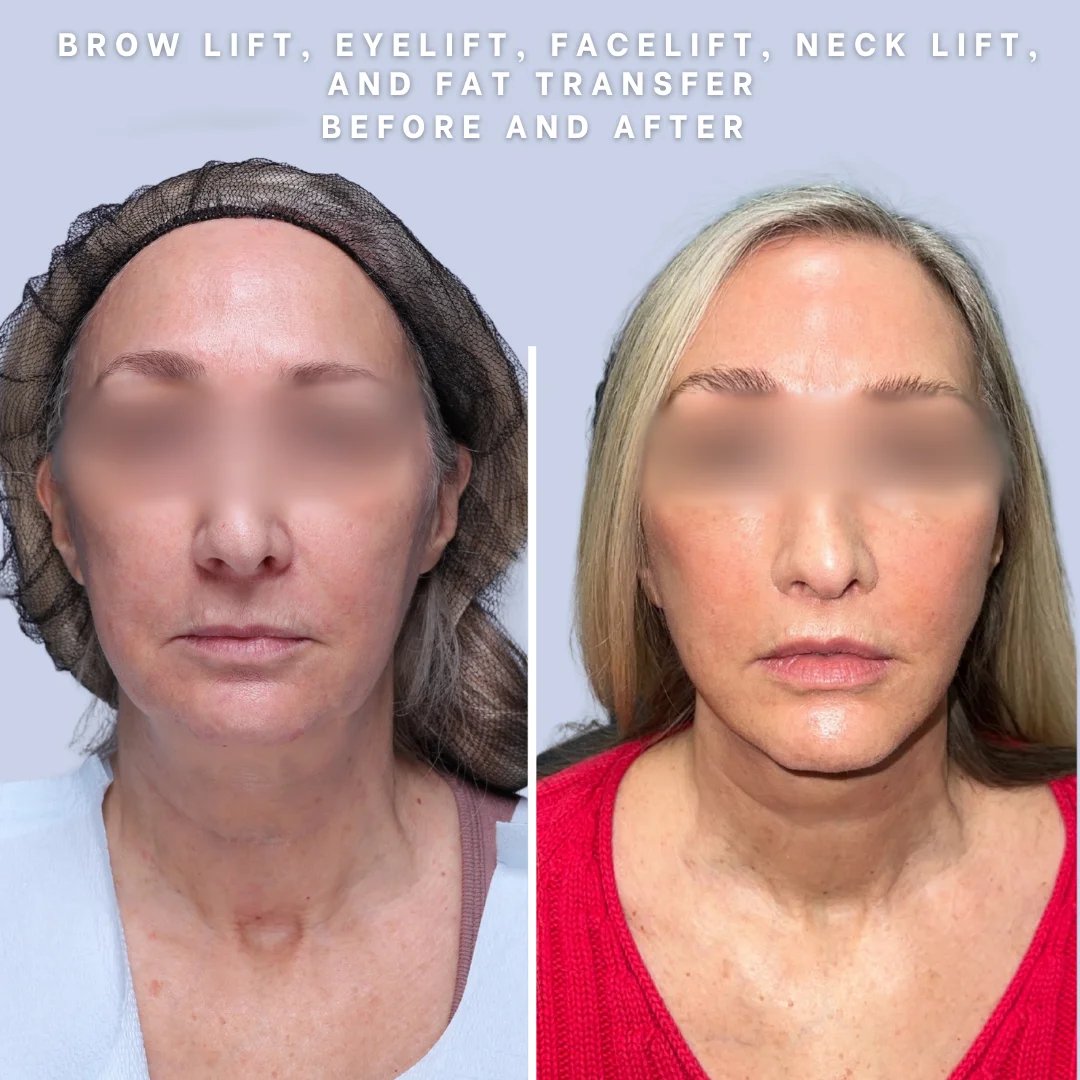 Face & Neck Before & After Gallery - Patient 18 - Image 4