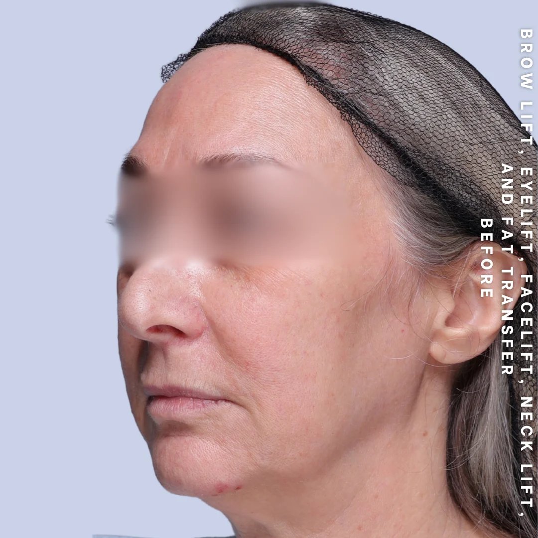Face & Neck Before & After Gallery - Patient 18 - Image 5