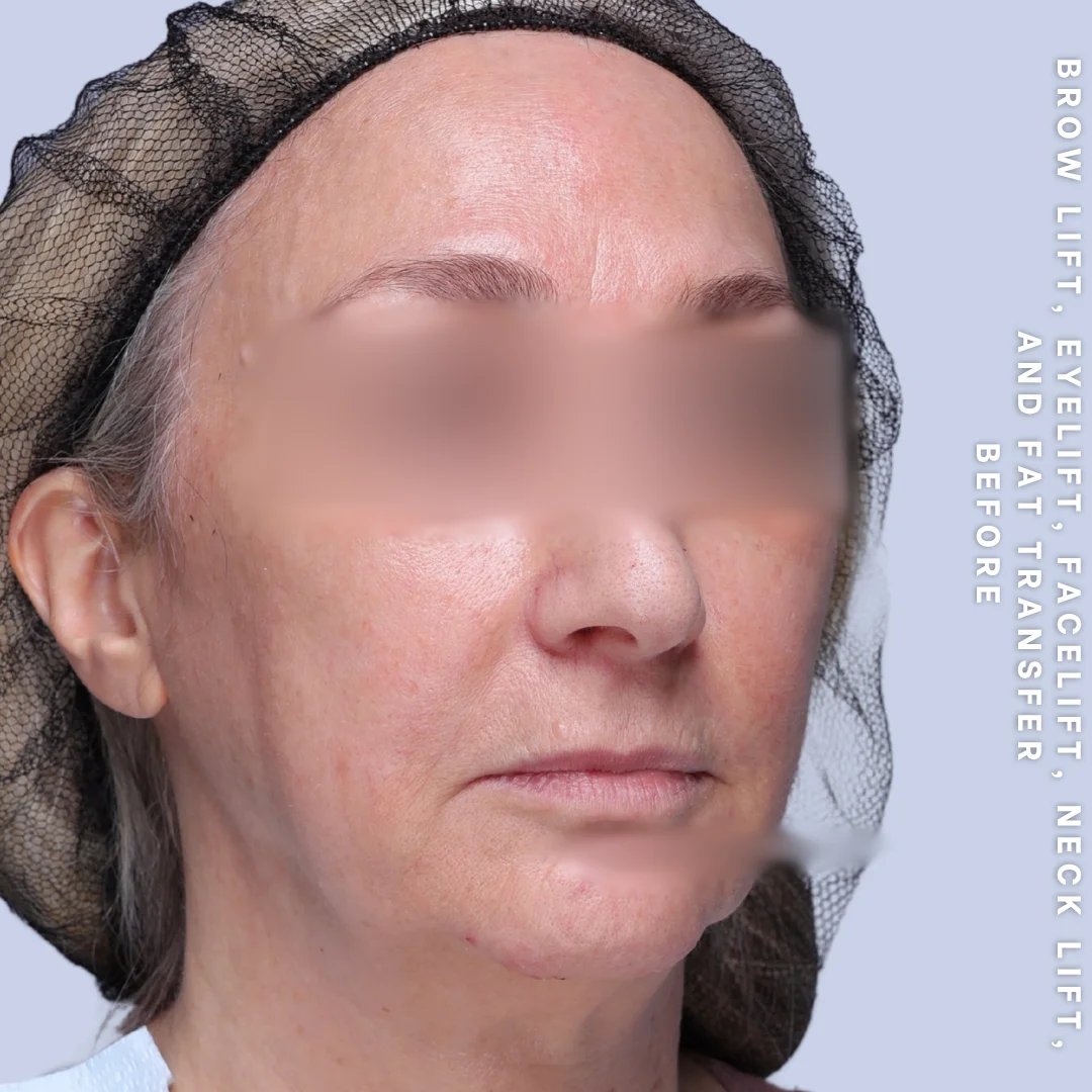 Face & Neck Before & After Gallery - Patient 18 - Image 6
