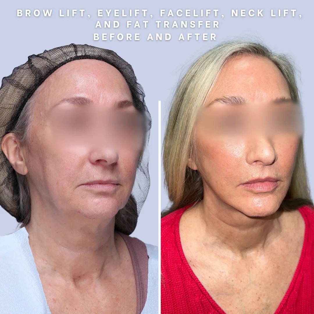 Face & Neck Before & After Gallery - Patient 18 - Image 7