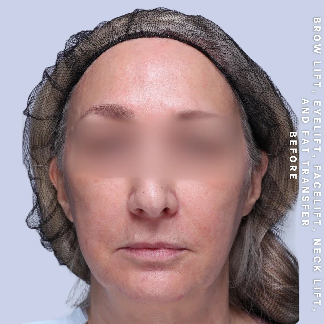 Face & Neck Before & After Gallery - Patient 18 - Image 8
