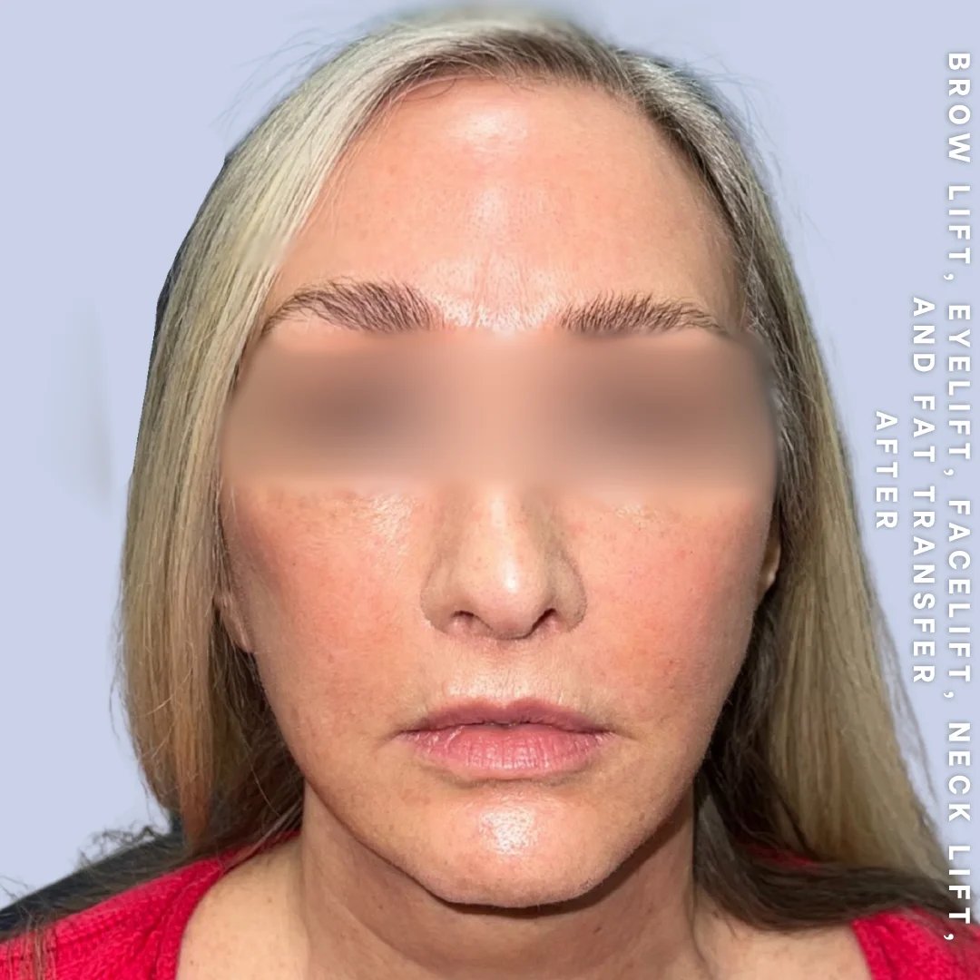 Face & Neck Before & After Gallery - Patient 18 - Image 9