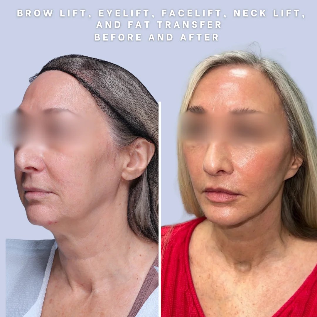 Face & Neck Before & After Gallery - Patient 18 - Image 10