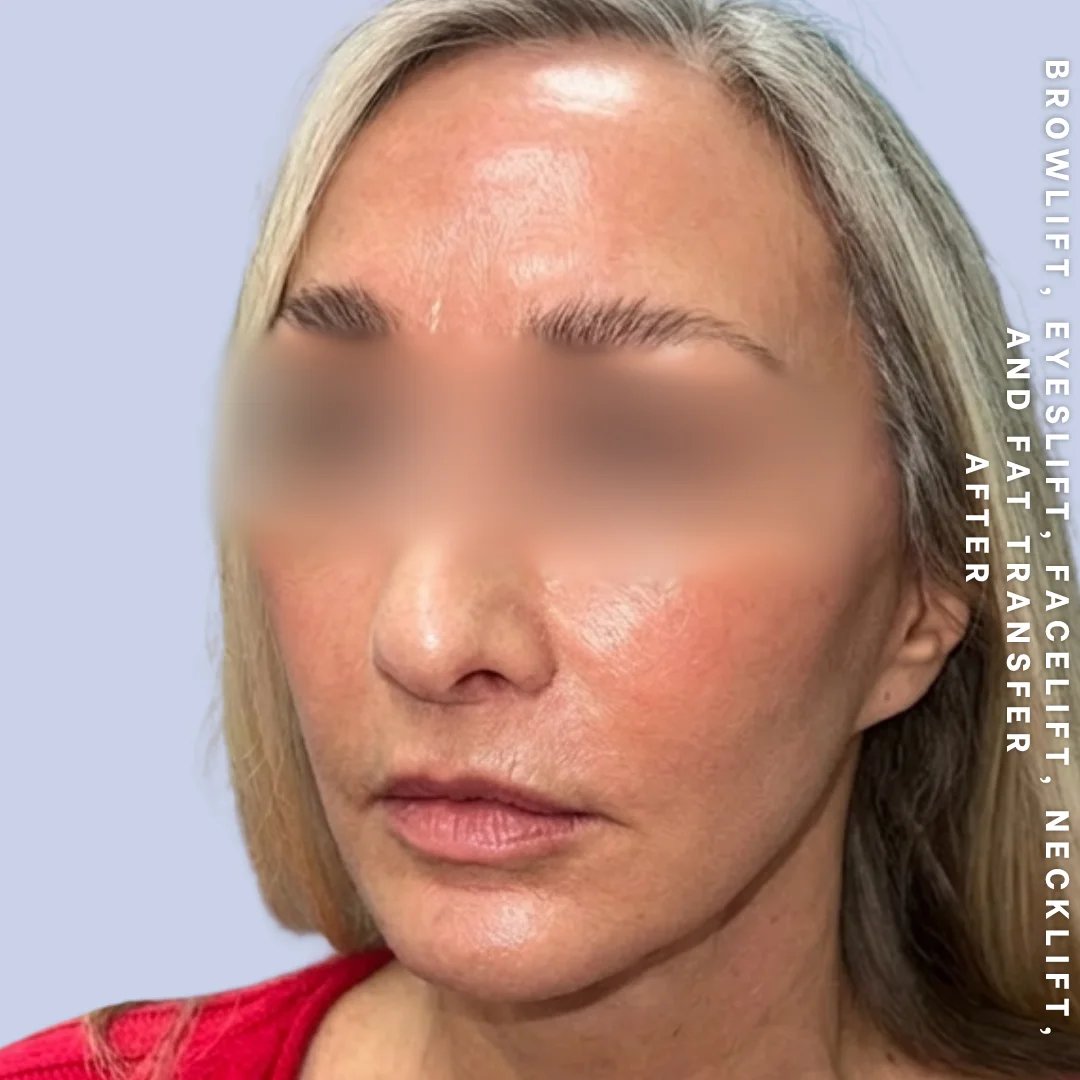 Face & Neck Before & After Gallery - Patient 18 - Image 11
