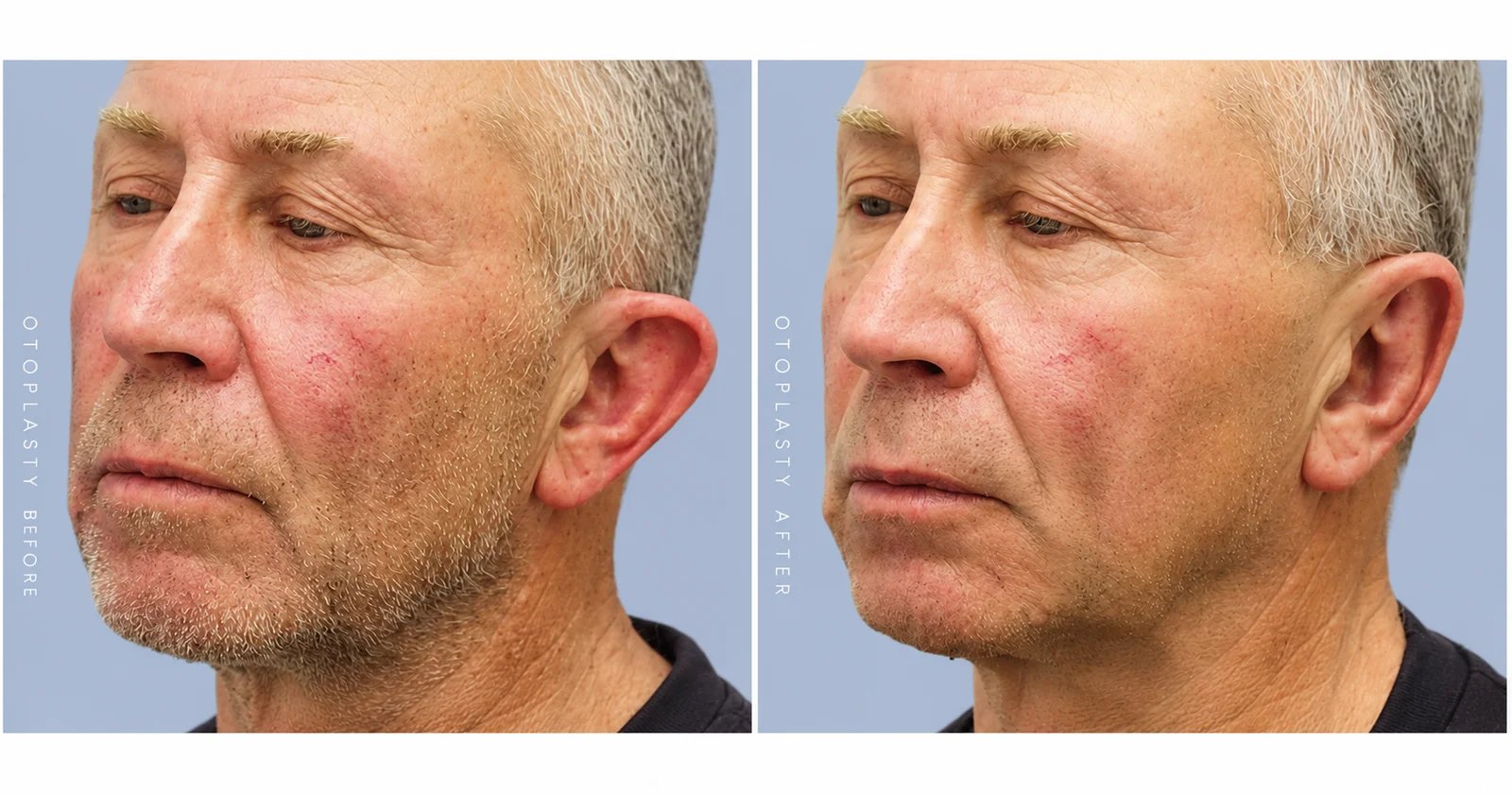 Adult otoplasty before and after (oblique view) by Dr. Hardik Doshi
