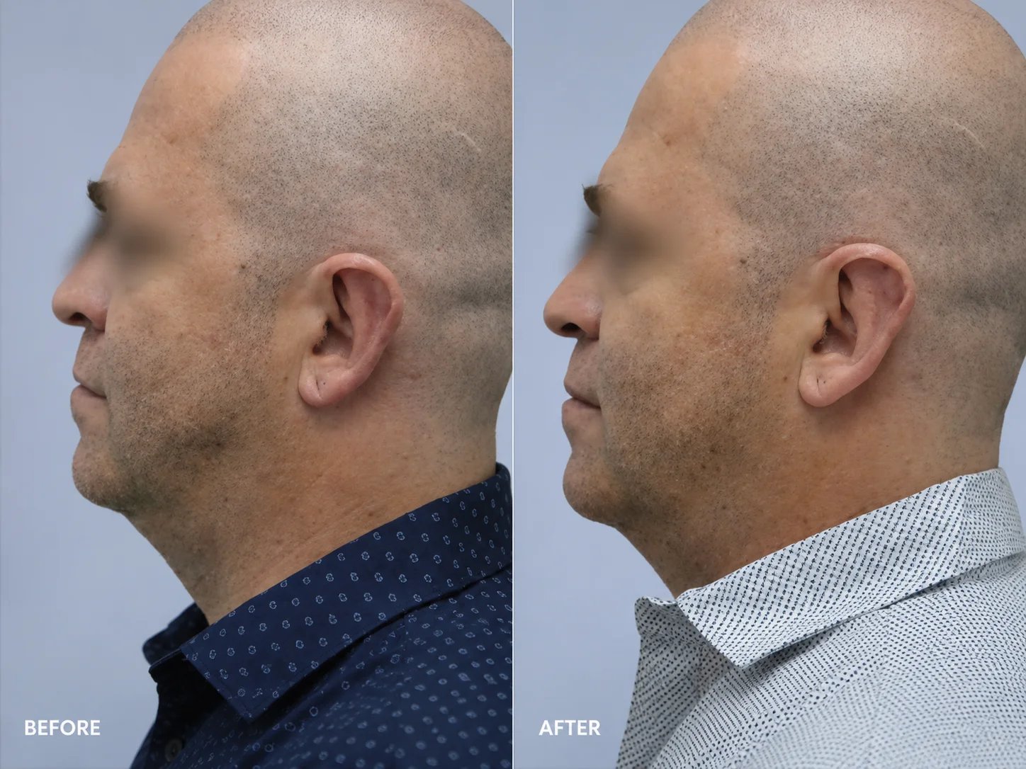 Adult otoplasty before and after (profile view) by Dr. Hardik Doshi