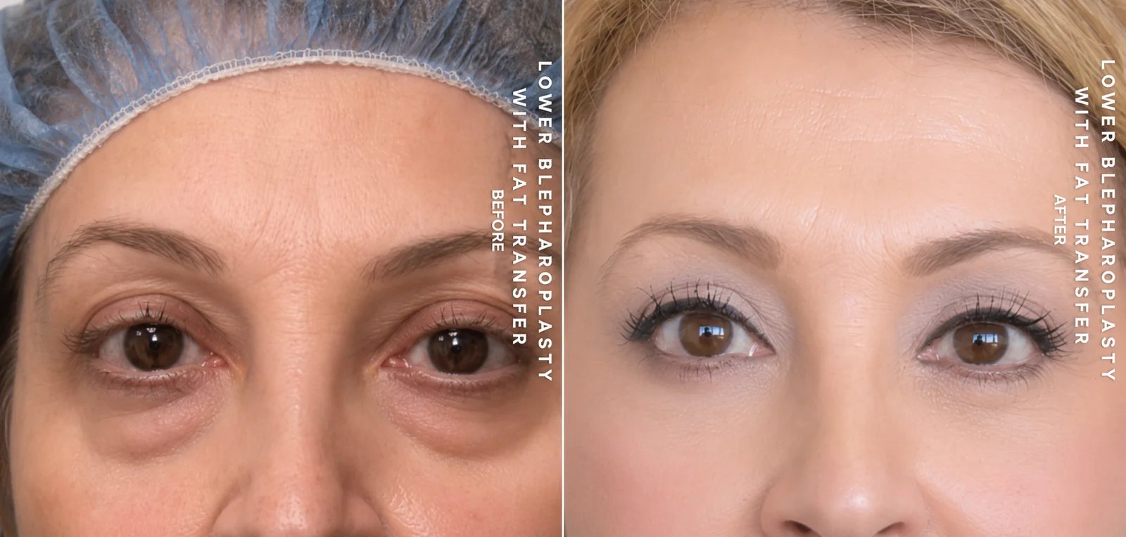 Lower blepharoplasty with fat transfer before and after — Doshi Plastic Surgery, Long Island