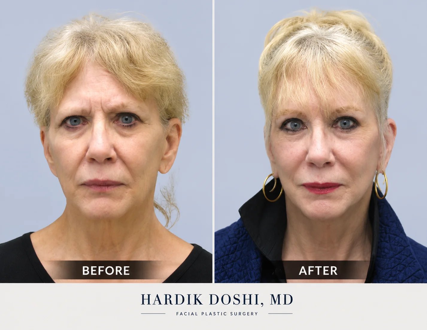 Brow lift before and after — Doshi Plastic Surgery, Long Island