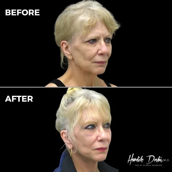 Brow lift before and after result — Doshi Plastic Surgery, Long Island
