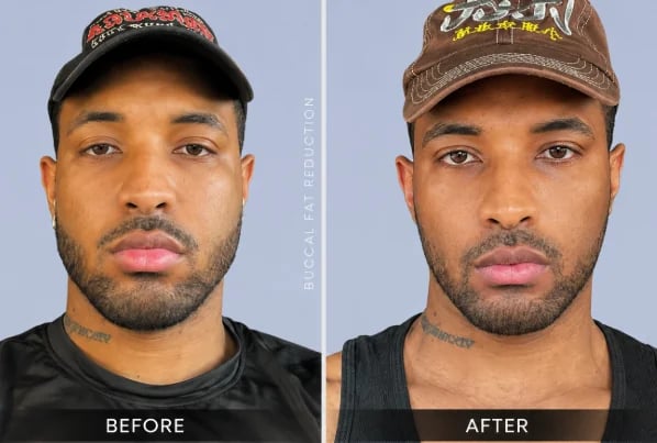 Buccal fat removal before and after result showing slimmer, more contoured cheeks — Doshi Plastic Surgery, Long Island