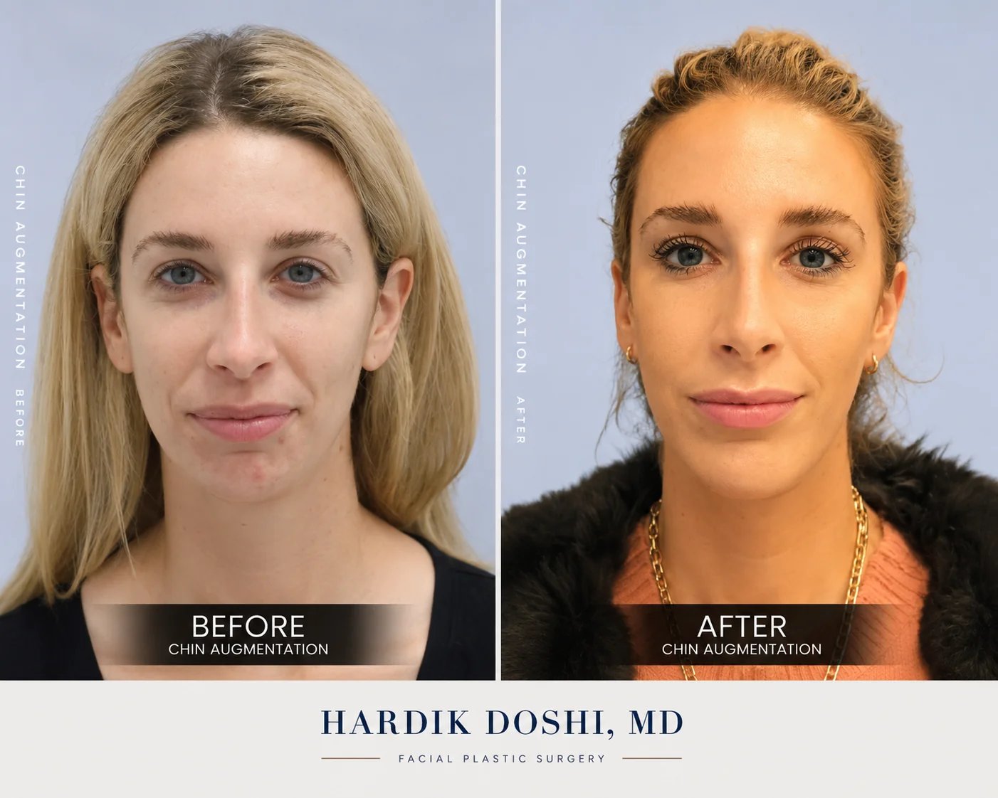 Chin augmentation before and after, front view — Doshi Plastic Surgery, Long Island