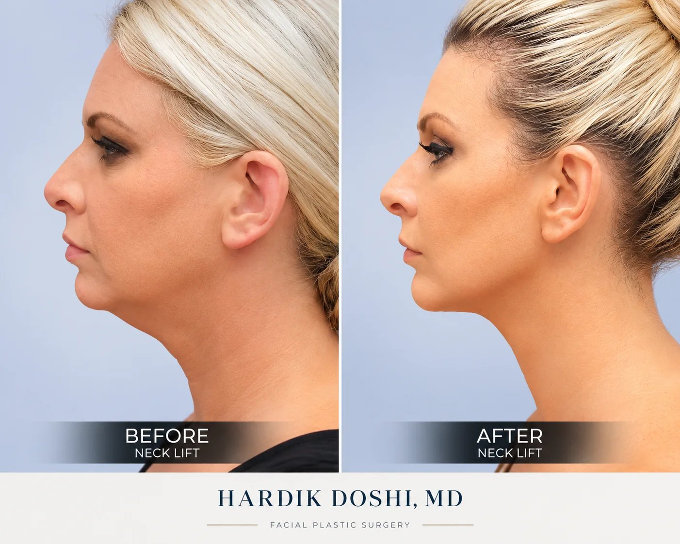 Profile before and after showing improved chin and neck definition — Doshi Plastic Surgery, Long Island