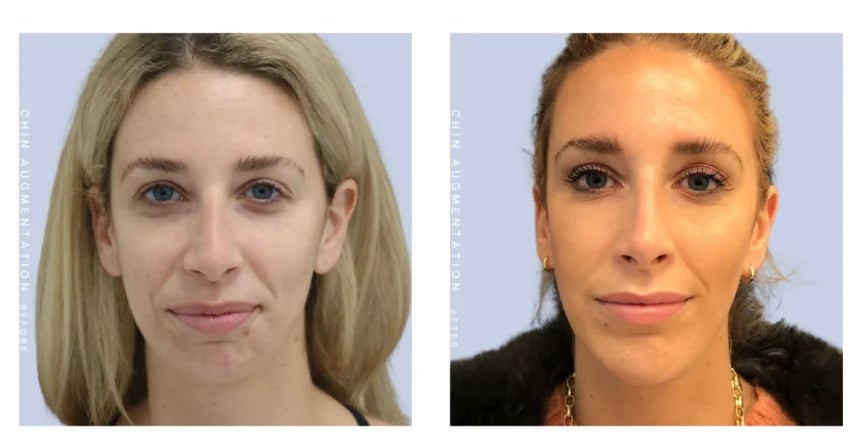 Chin augmentation before and after — front-view comparison of a female patient, Doshi Plastic Surgery, Long Island