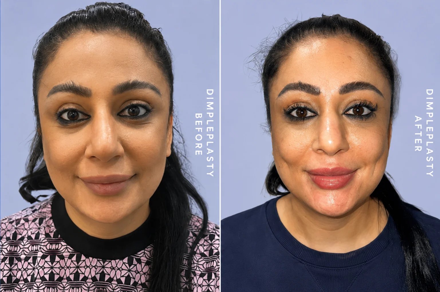 Dimpleplasty before and after — full-face result showing new cheek dimples after surgery