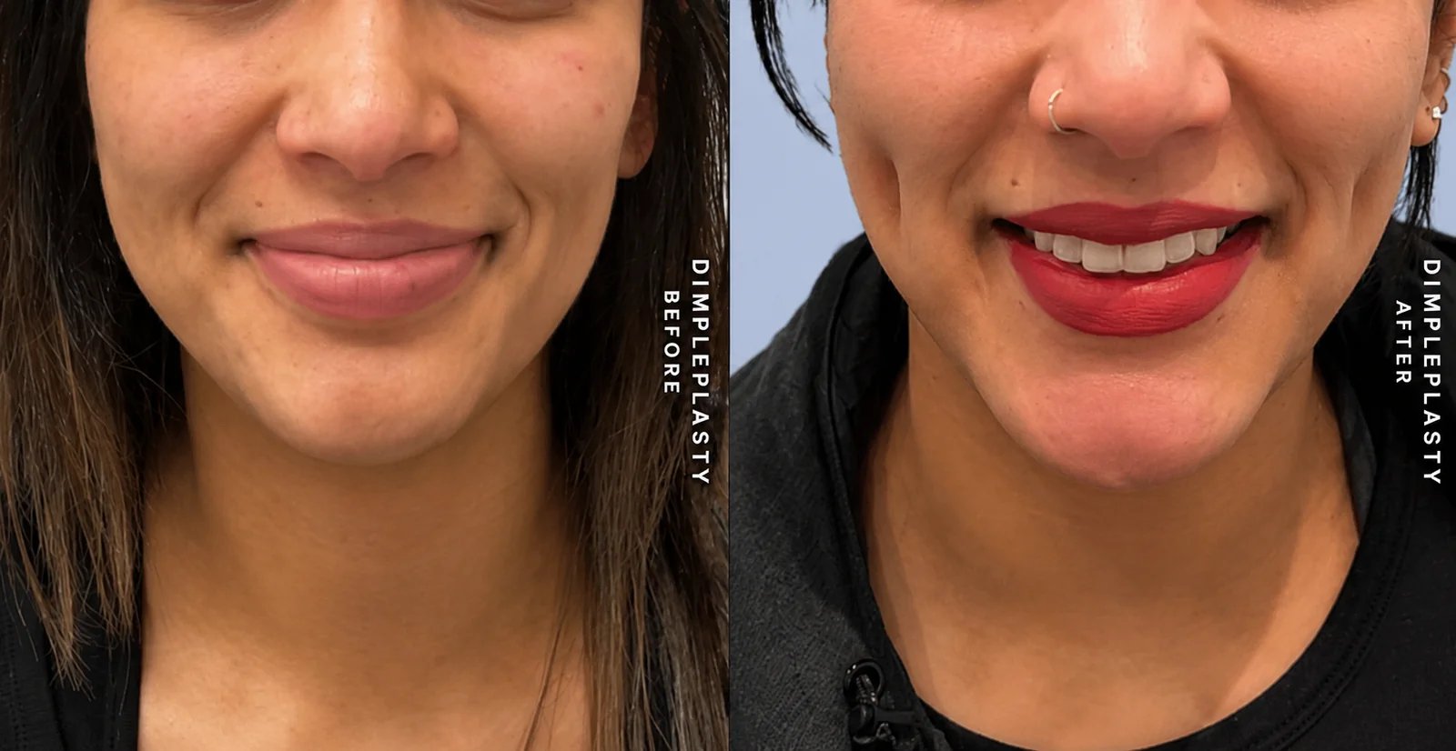 Dimpleplasty before and after — close-up of a smile showing visible cheek dimples after the procedure