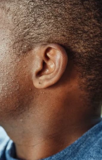 Close-up of an earlobe, the small structure earlobe repair works on