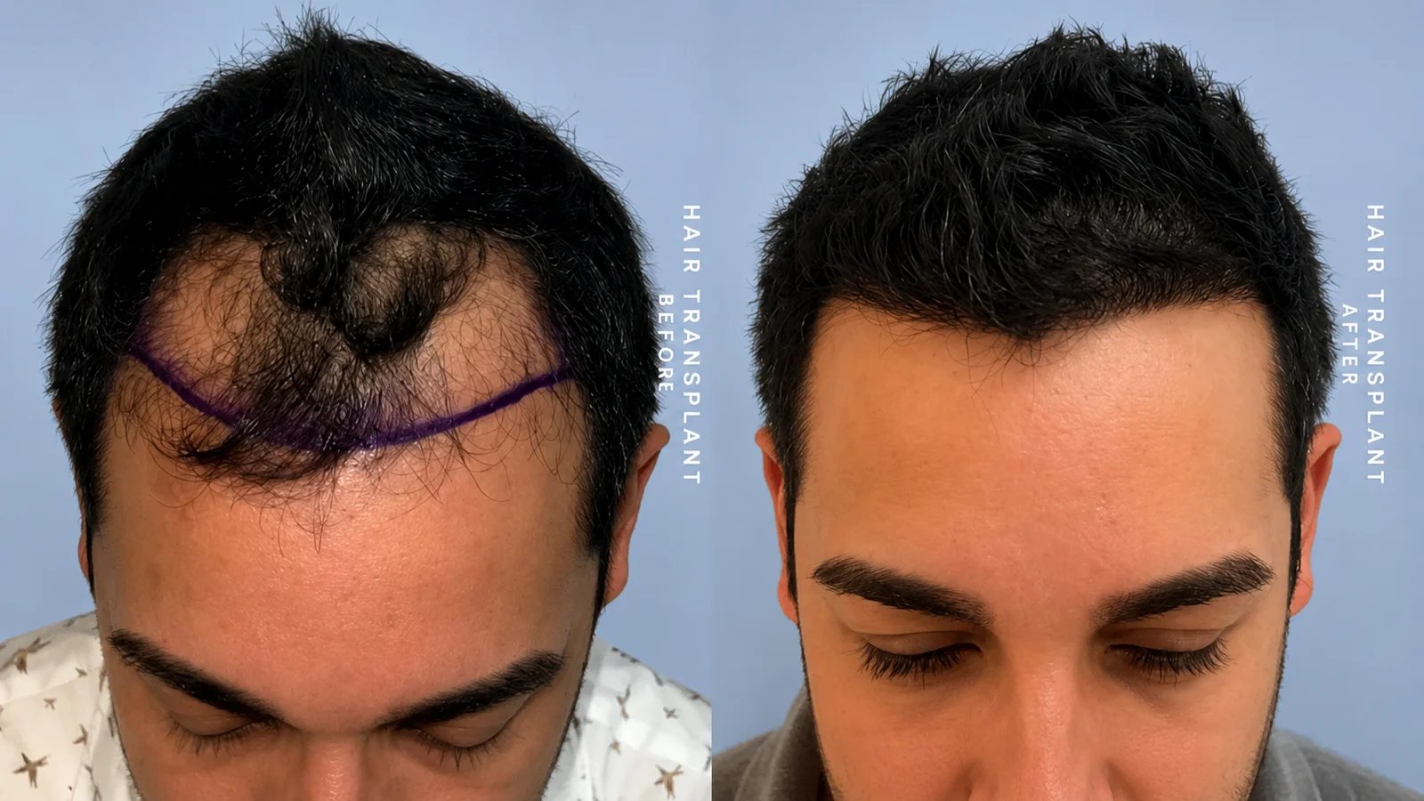 Hair transplant before and after — Doshi Plastic Surgery, Long Island
