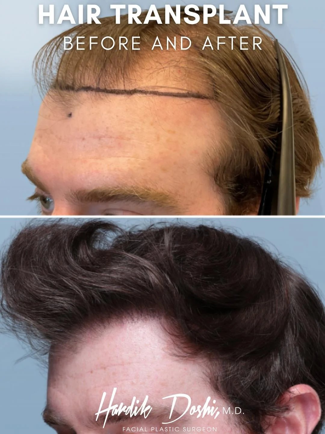 Hair transplant before and after — Doshi Plastic Surgery, Long Island