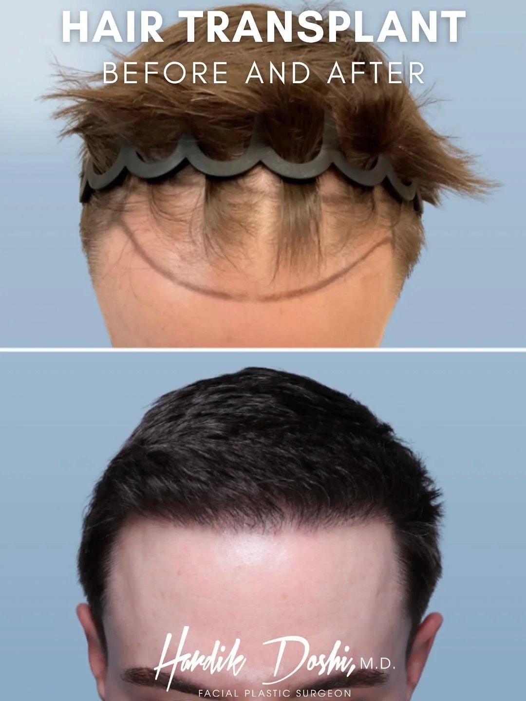 hair transplant results