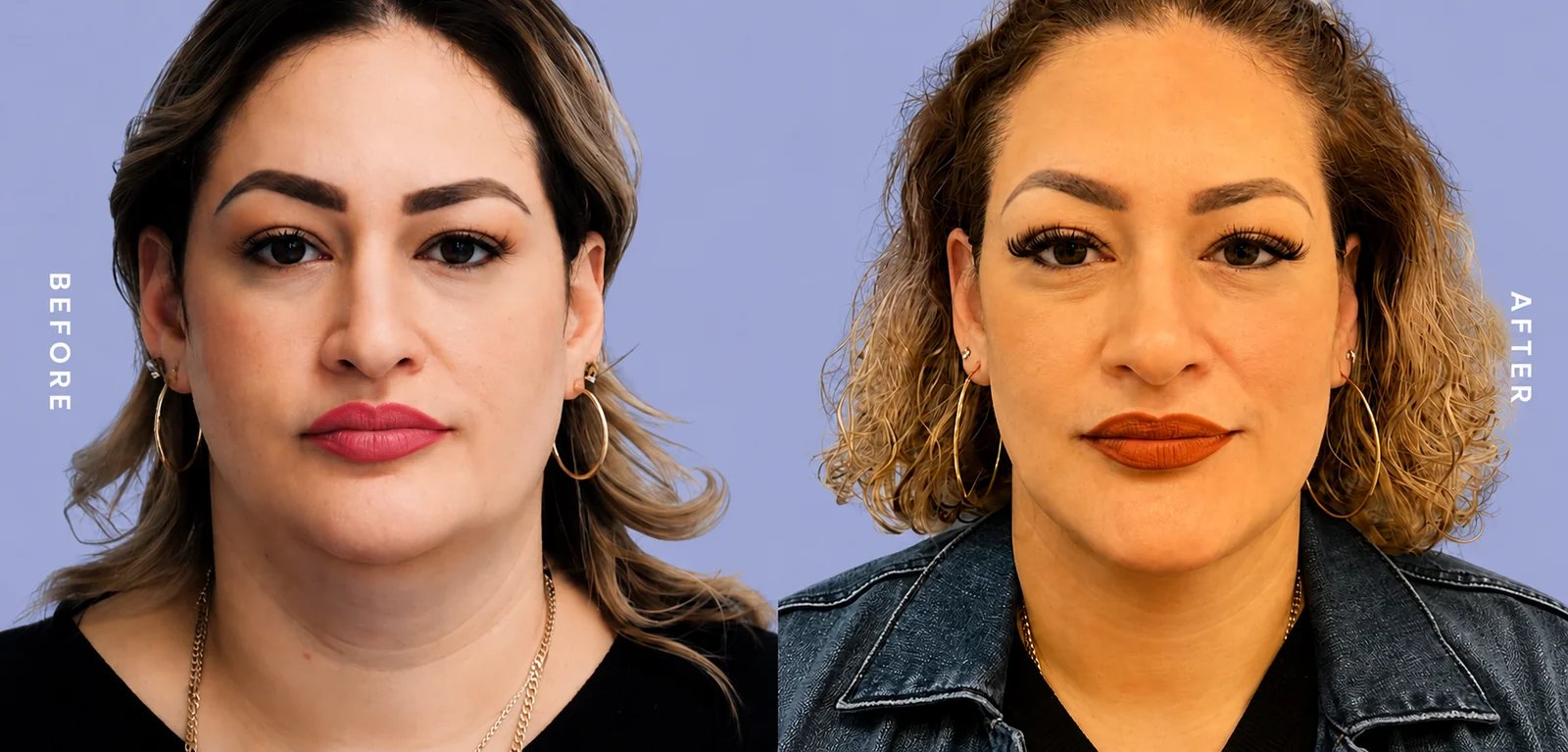 Jawline contouring before and after — female patient front view showing improved lower-face definition, Doshi Plastic Surgery, Long Island