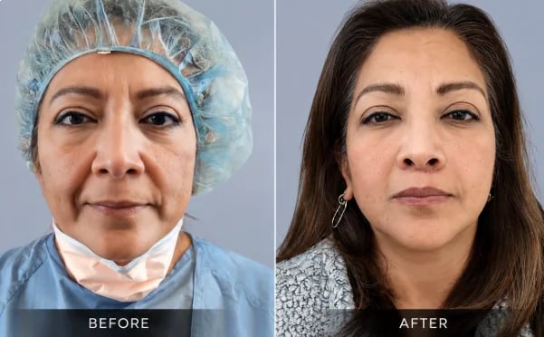 Lip lift before and after result — Doshi Plastic Surgery, Long Island