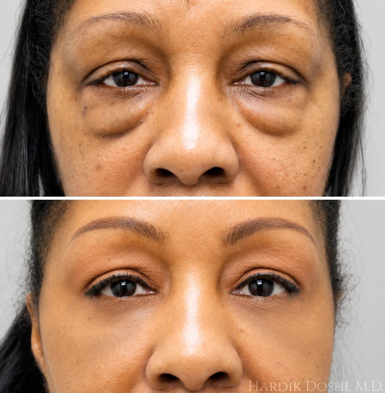Lower blepharoplasty before and after by Dr. Hardik Doshi