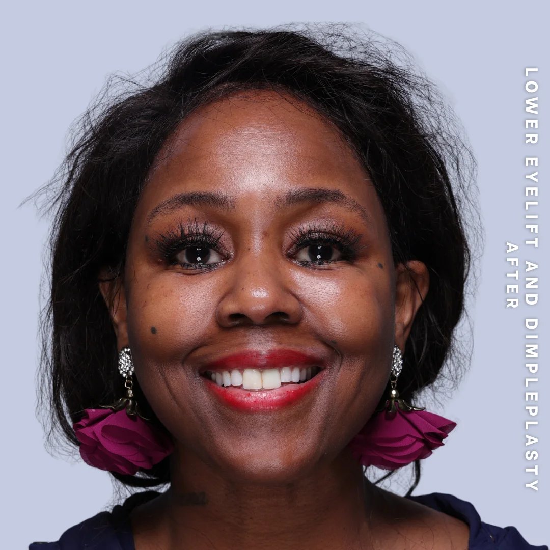 Dimpleplasty Before & After Gallery - Patient 20260821 - Image 2