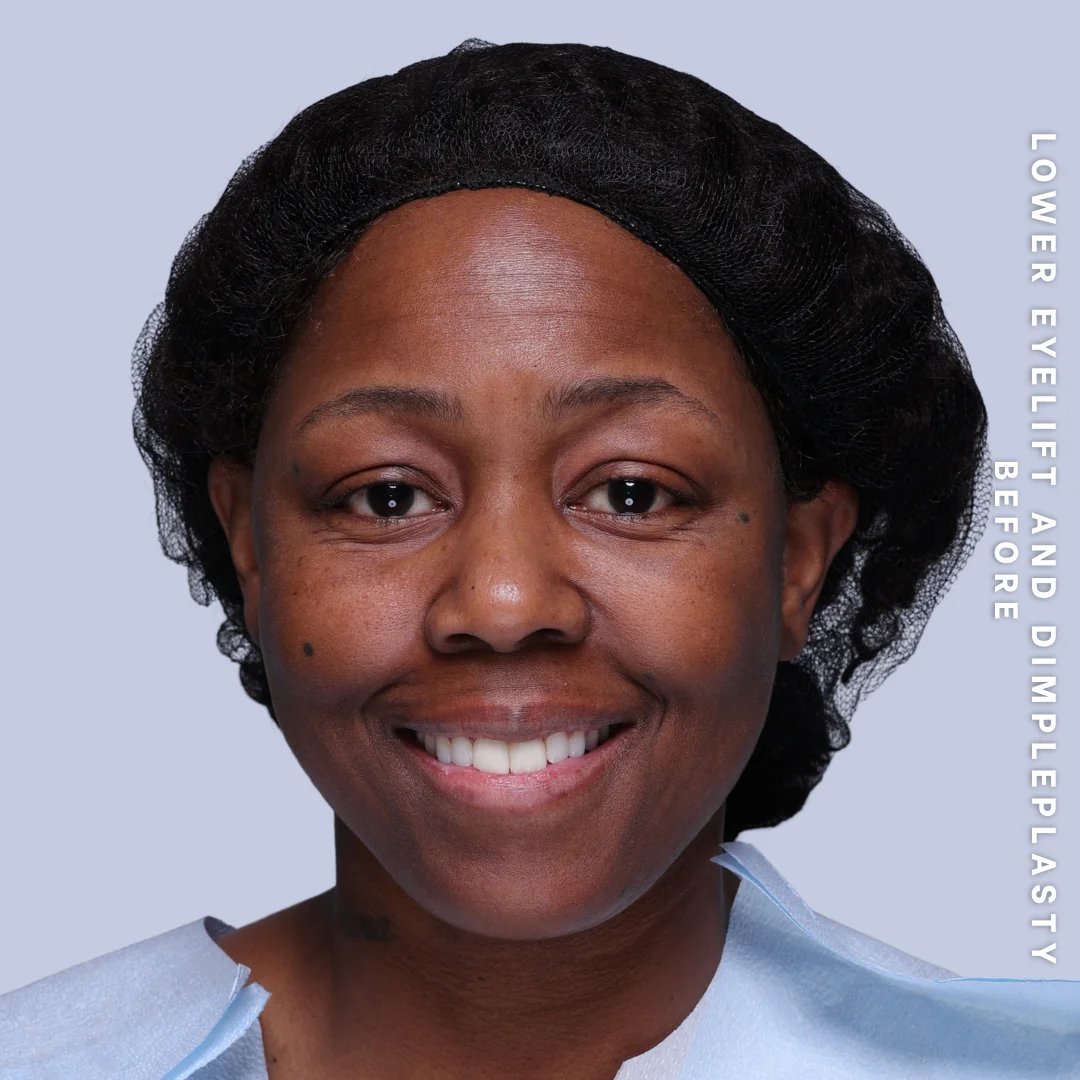 Dimpleplasty Before & After Gallery - Patient 20260821 - Image 1