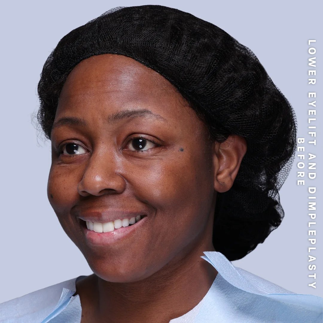 Dimpleplasty Before & After Gallery - Patient 20260821 - Image 3