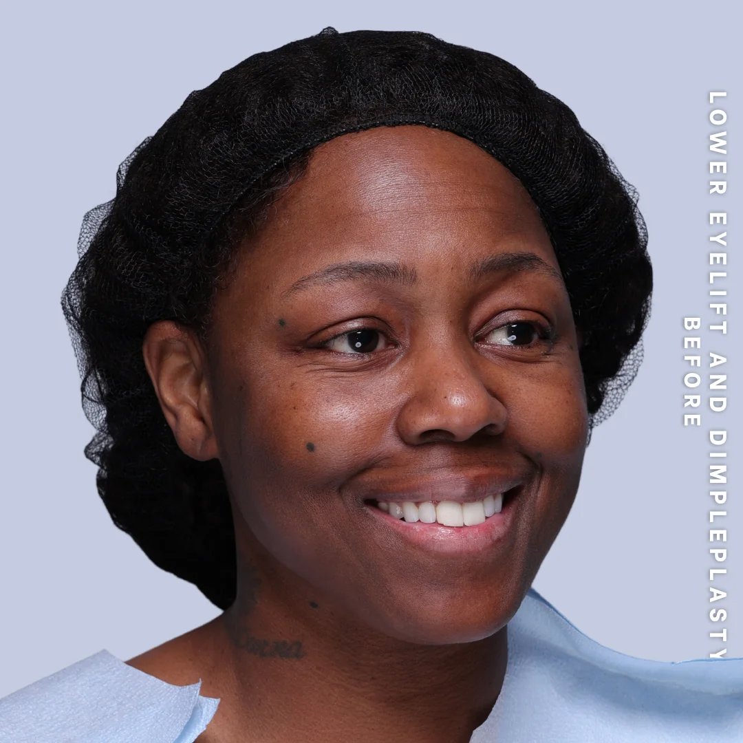 Dimpleplasty Before & After Gallery - Patient 20260821 - Image 5
