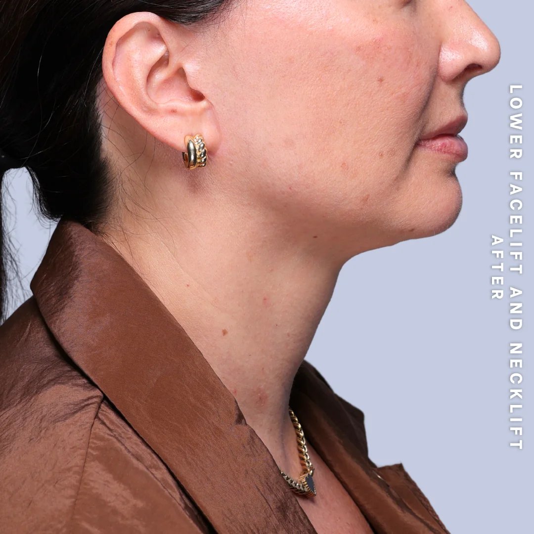 Face & Neck Before & After Gallery - Patient 19 - Image 2