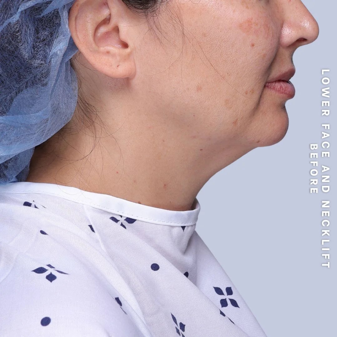 Face & Neck Before & After Gallery - Patient 19 - Image 1