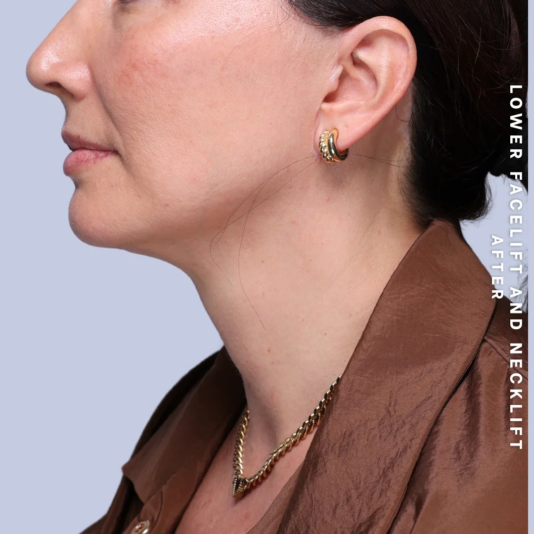 Face & Neck Before & After Gallery - Patient 19 - Image 4