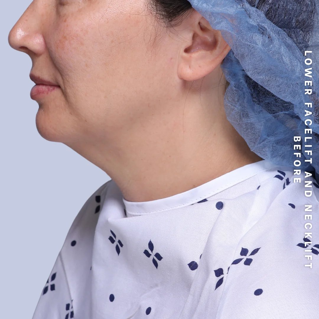 Face & Neck Before & After Gallery - Patient 19 - Image 3