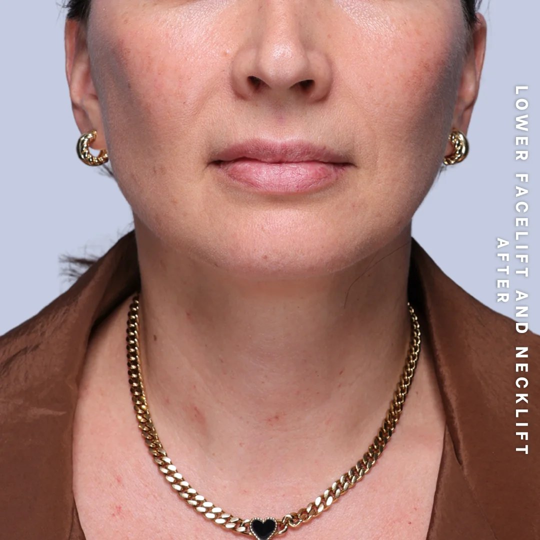 Face & Neck Before & After Gallery - Patient 19 - Image 6
