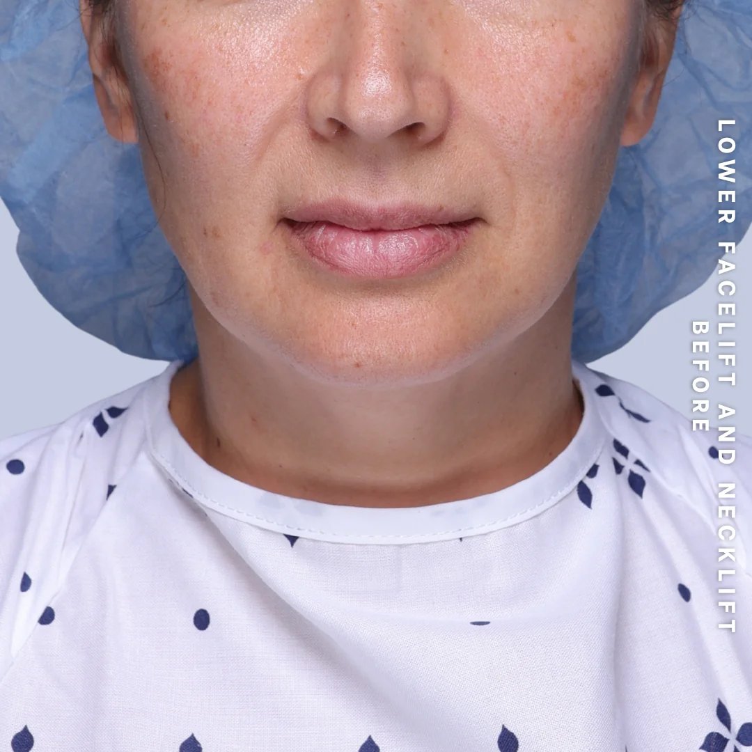 Face & Neck Before & After Gallery - Patient 19 - Image 5