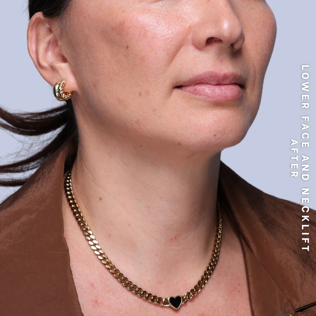 Face & Neck Before & After Gallery - Patient 19 - Image 8