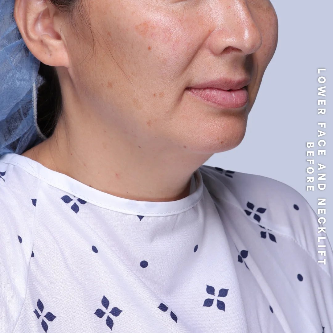 Face & Neck Before & After Gallery - Patient 19 - Image 7