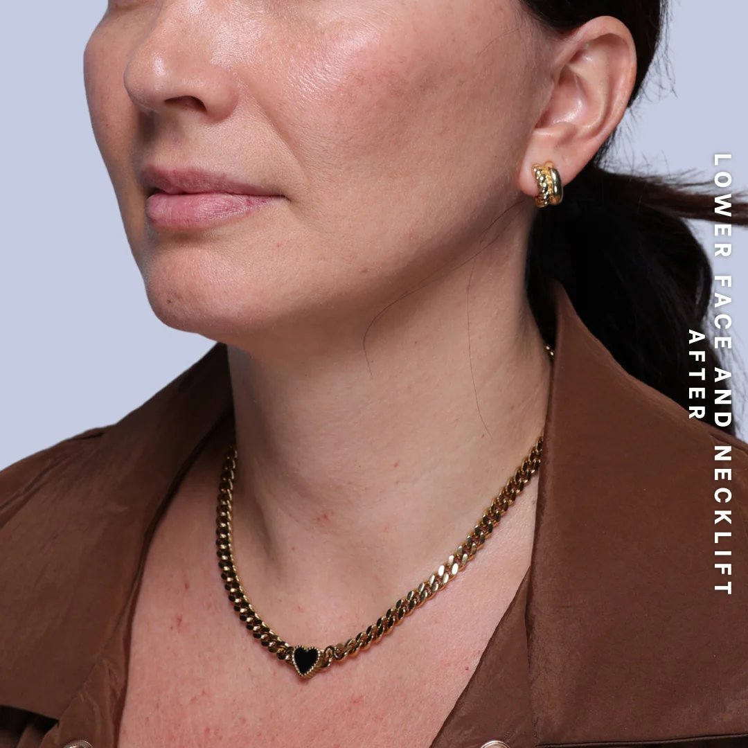 Face & Neck Before & After Gallery - Patient 19 - Image 10