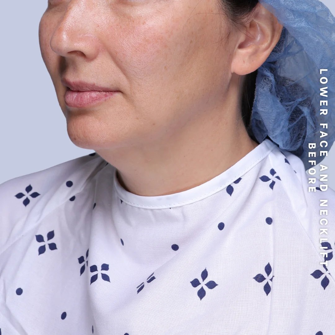 Face & Neck Before & After Gallery - Patient 19 - Image 9