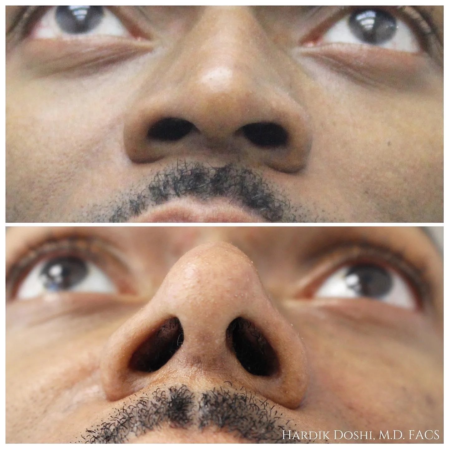 Male rhinoplasty before and after by Dr. Hardik Doshi