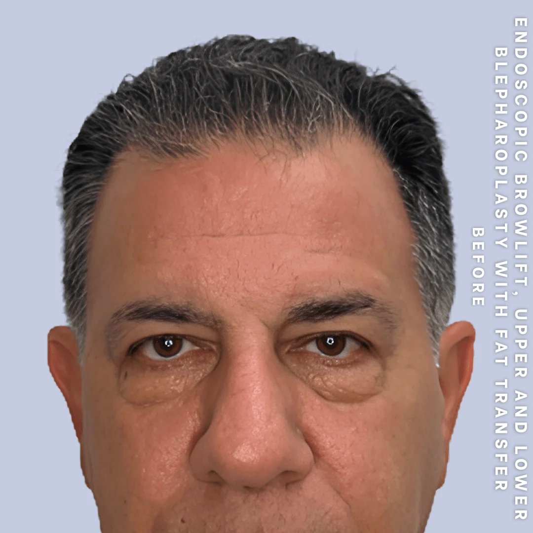 Men's Eyes Before & After Gallery - Patient 124584 - Image 1