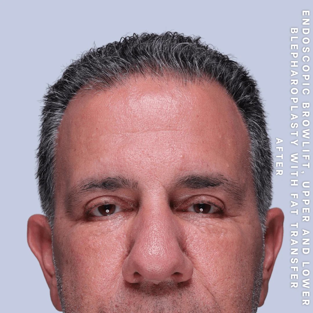 Men's Eyes Before & After Gallery - Patient 124584 - Image 2
