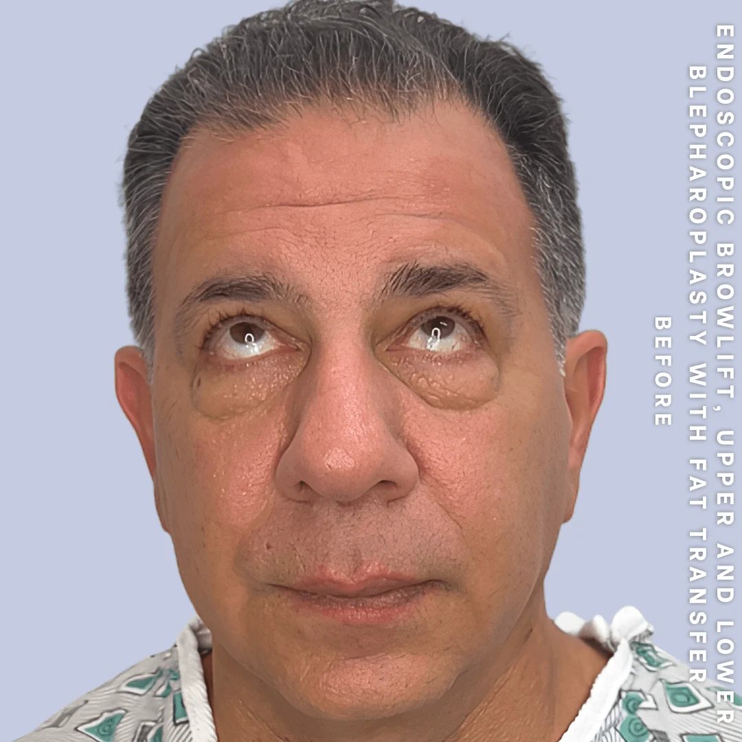 Men's Eyes Before & After Gallery - Patient 124584 - Image 3