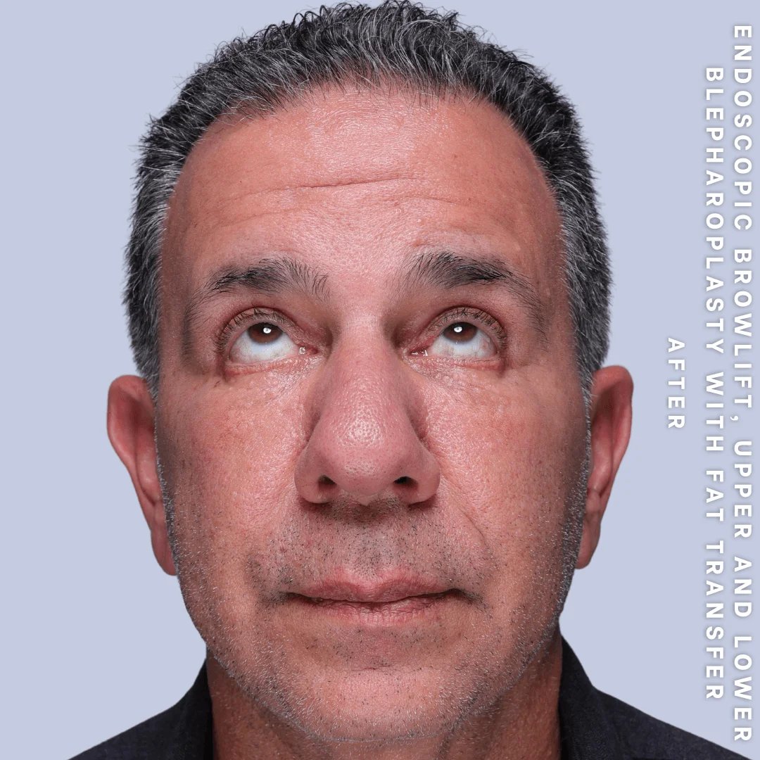 Men's Eyes Before & After Gallery - Patient 124584 - Image 4