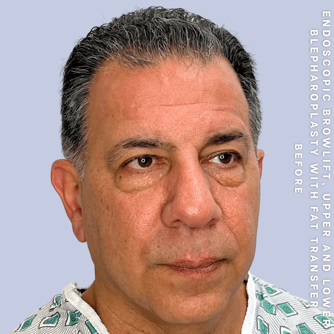 Men's Eyes Before & After Gallery - Patient 124584 - Image 5