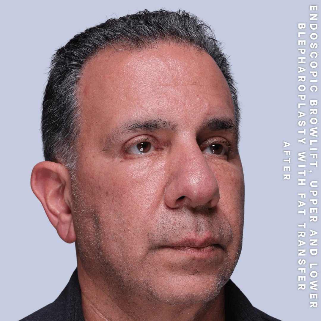 Men's Eyes Before & After Gallery - Patient 124584 - Image 6