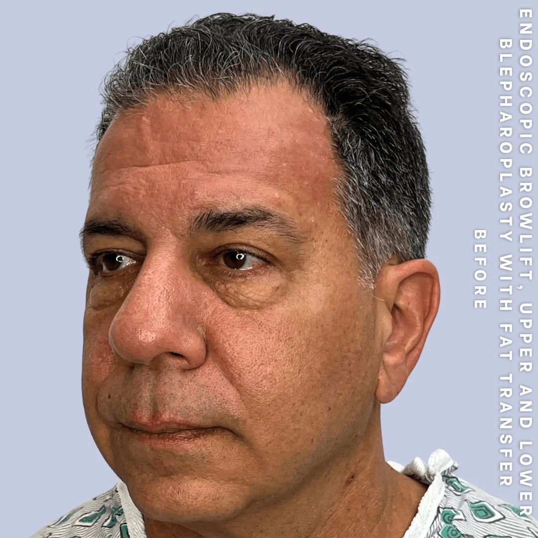 Men's Eyes Before & After Gallery - Patient 124584 - Image 7