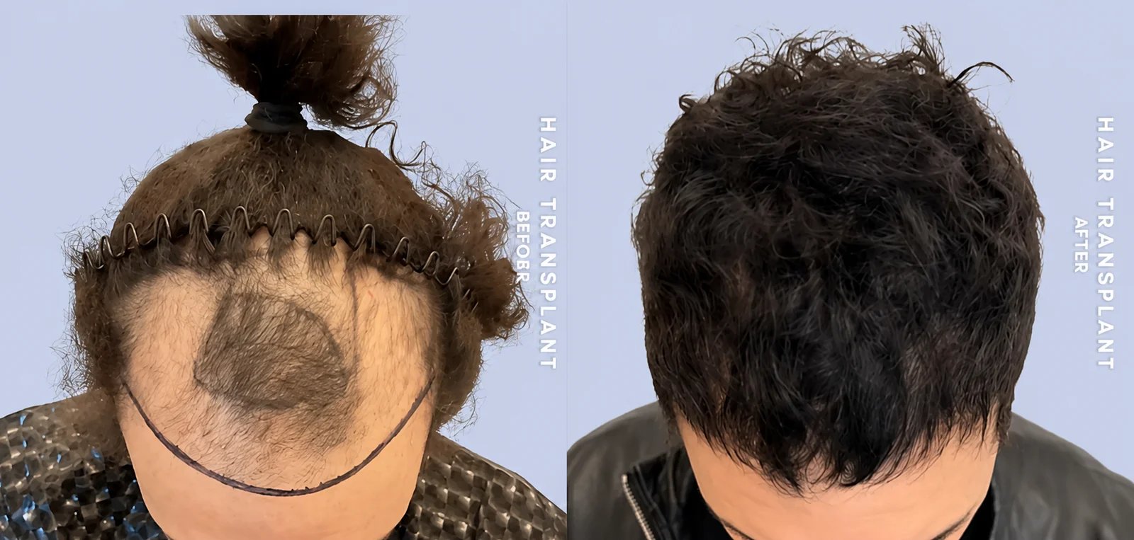 Men's hair transplant before and after — Doshi Plastic Surgery, Long Island